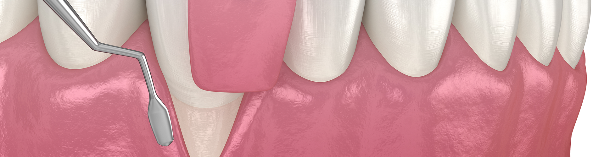 rendering of a gum graft being placed