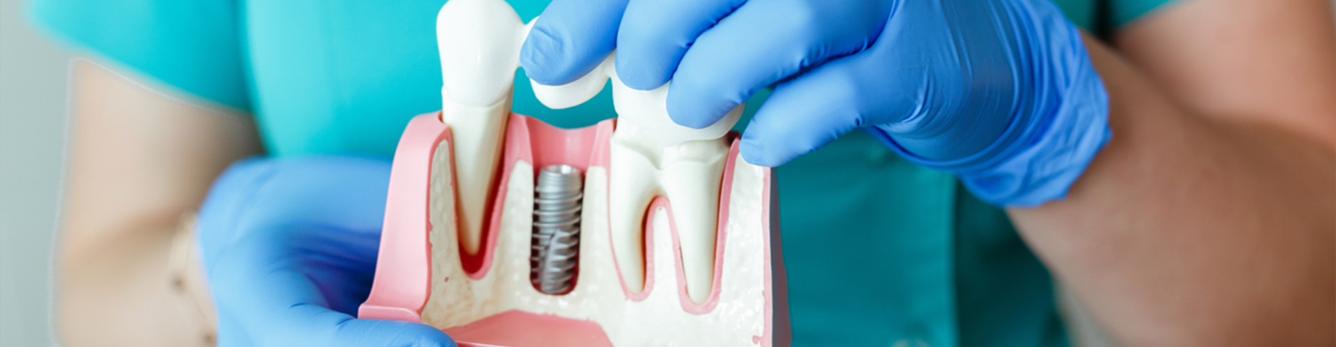 model of a dental bridge with implant