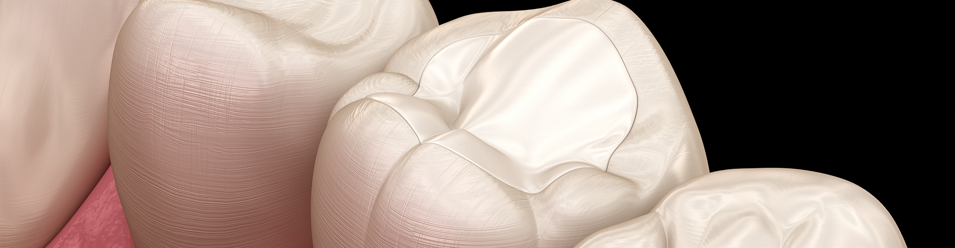 rendering of a tooth with a white filling between other teeth