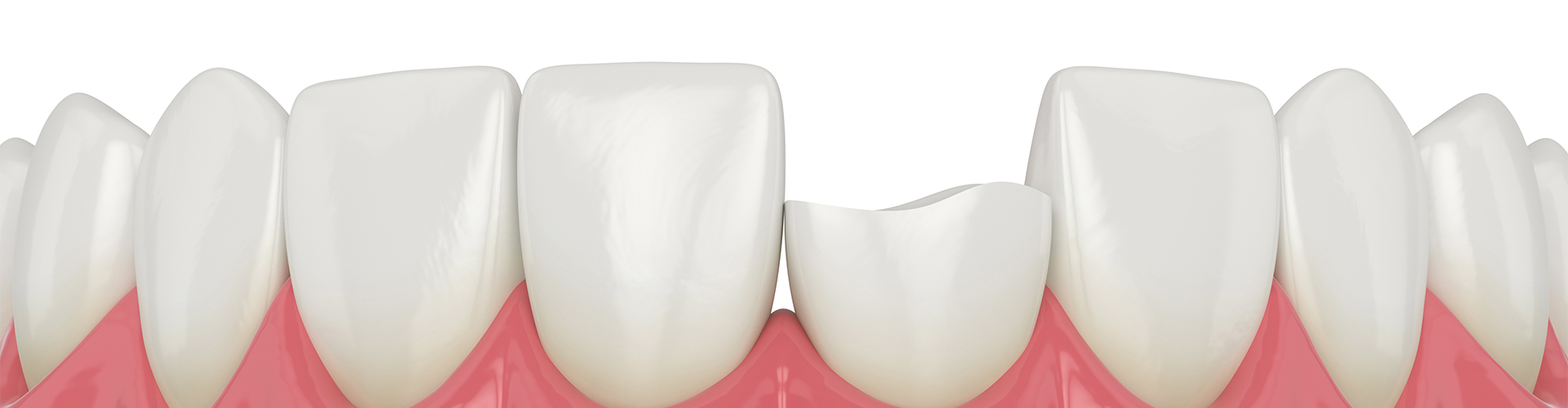 rendering of lower teeth with one broken