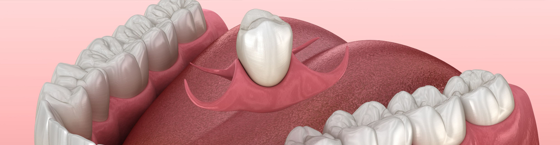 rendering of a partial denture being placed