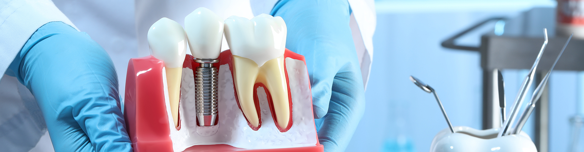 Model of a dental implant between teeth.