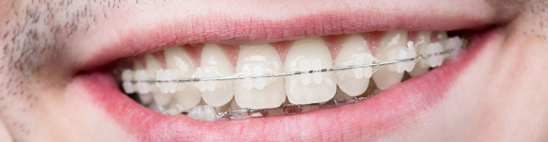 smile with ceramic braces