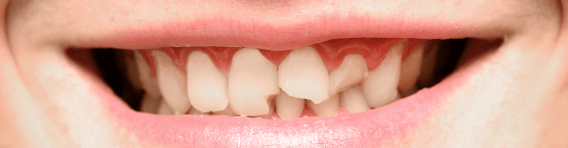 Smile with broken front teeth.