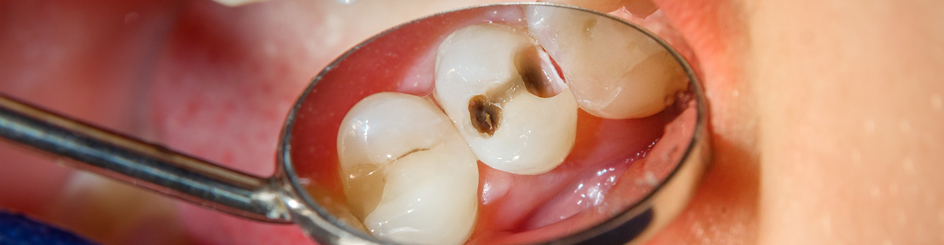 dental mirror reflecting cavities in open mouth