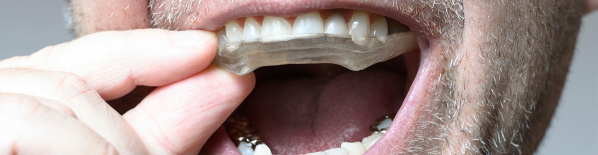 Man placing night guard in his mouth.