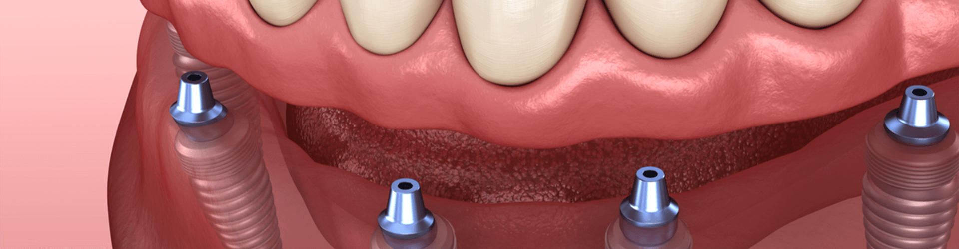 Rendering of all all-on-4 dental implants.