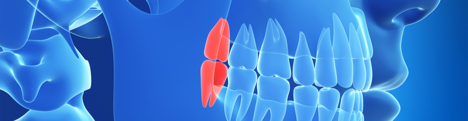 rendering of a jaw x-ray with wisdom teeth in red