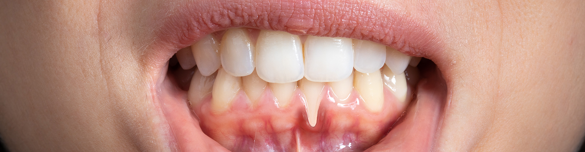 woman pulling down lower lip to show receeding gums