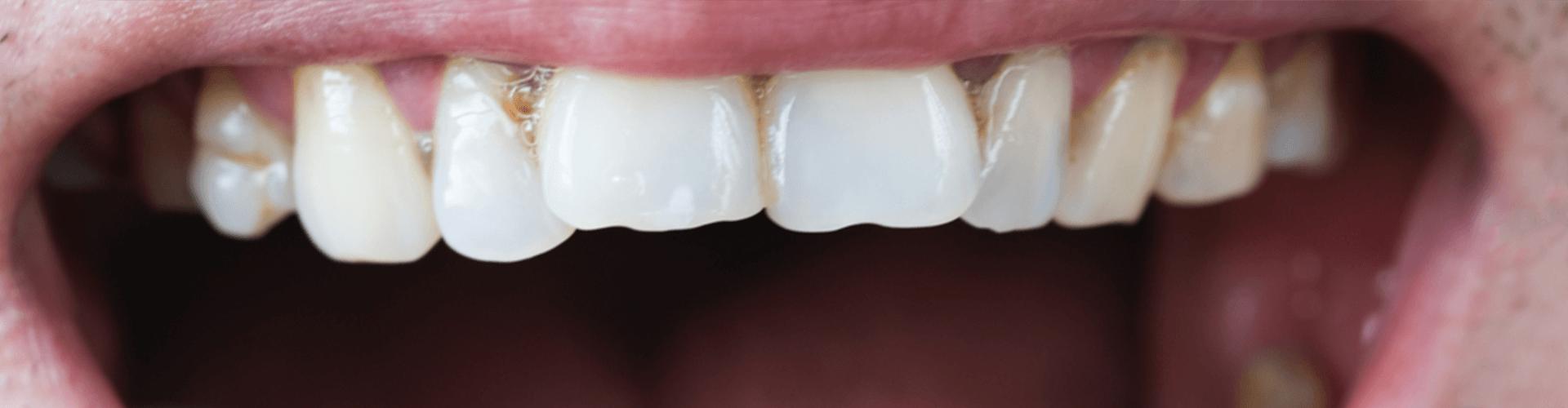 Mouth with tooth decay.