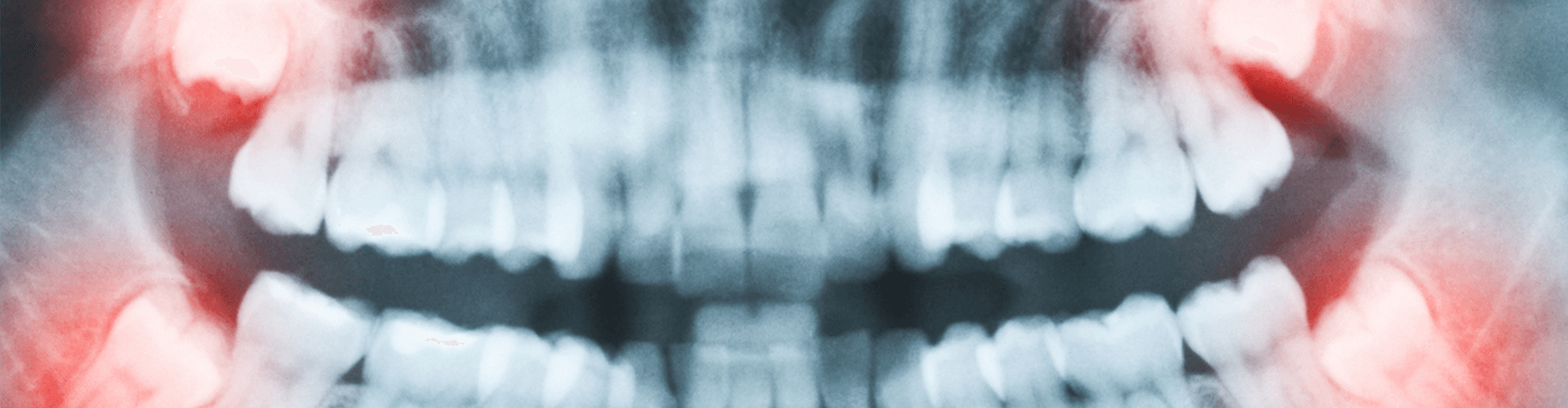 Dental x-ray of mouth with wisdom teeth highlighted.