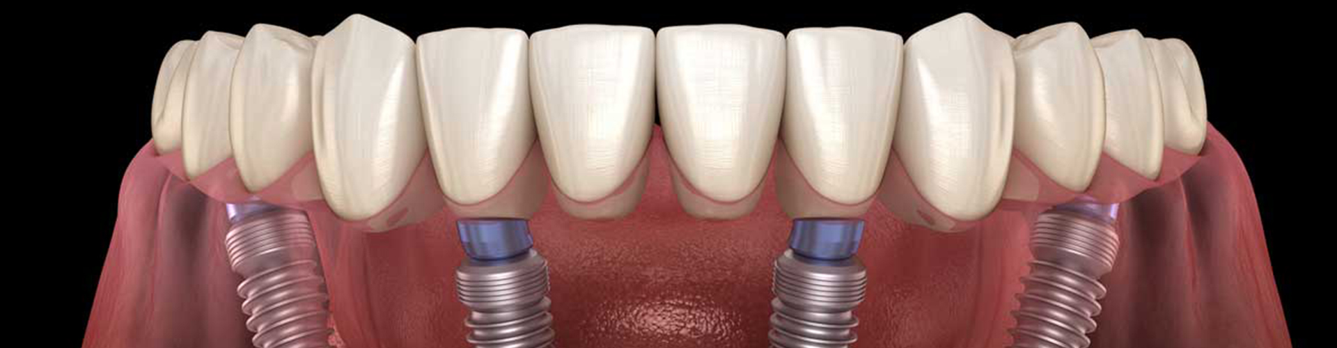 Rendering of all-on-4 dental implants.