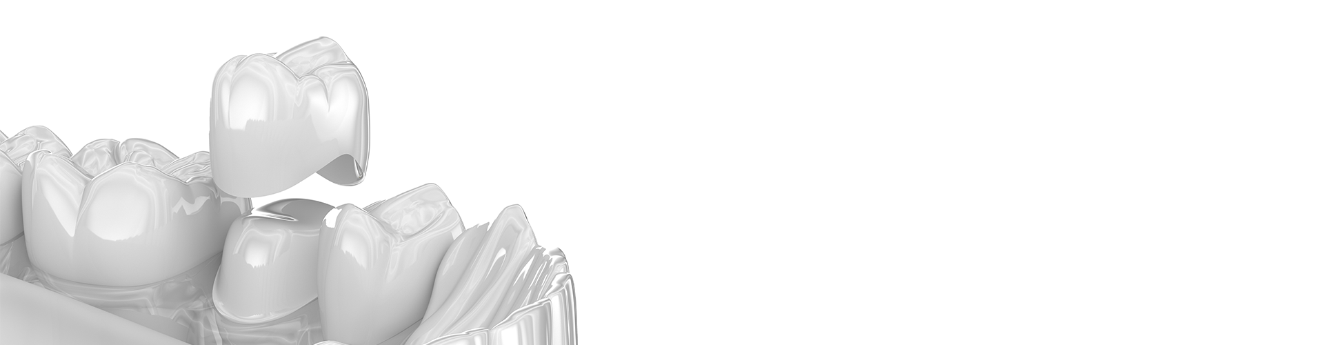 rendering of a crown being placed over a filed-down tooth