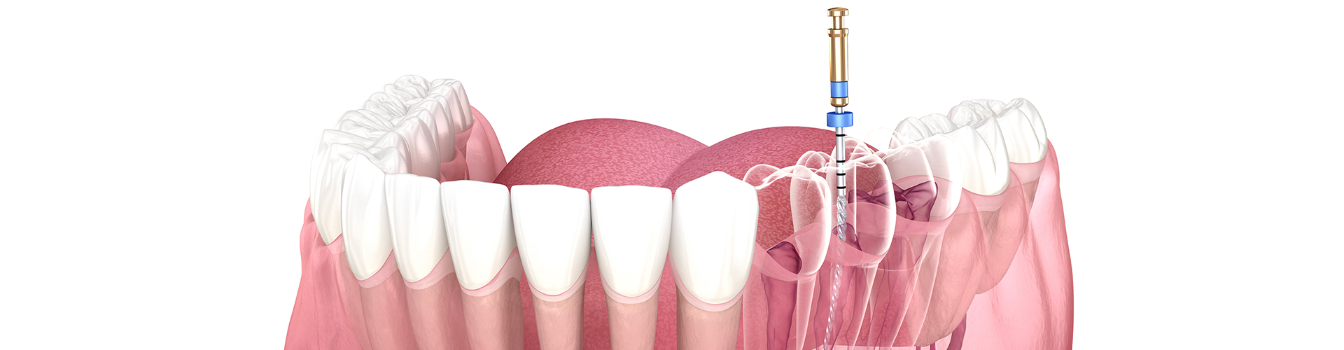 rendering of a tooth receiving root canal treatment