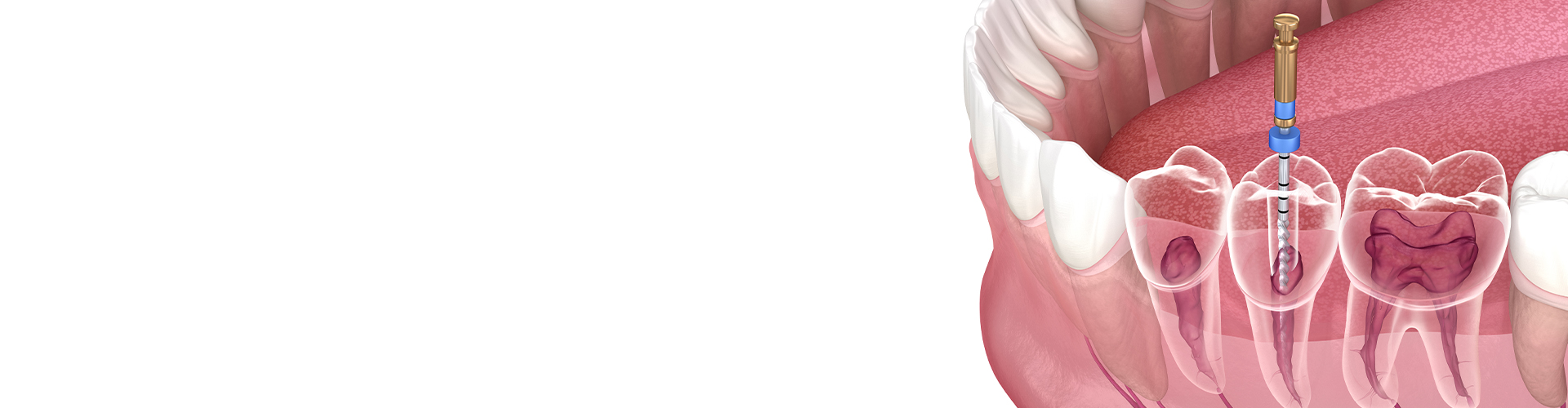 rendering of lower jaw with tooth getting root canal treatment