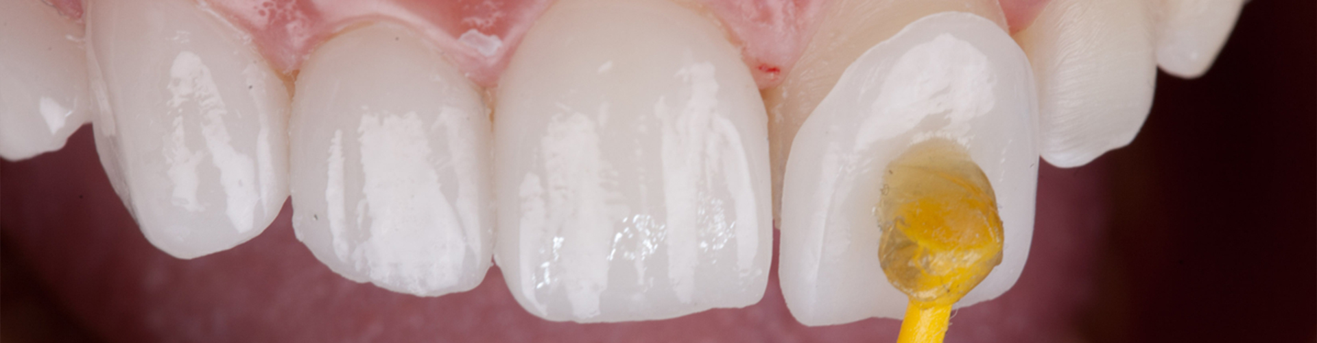 application of a Lumineer