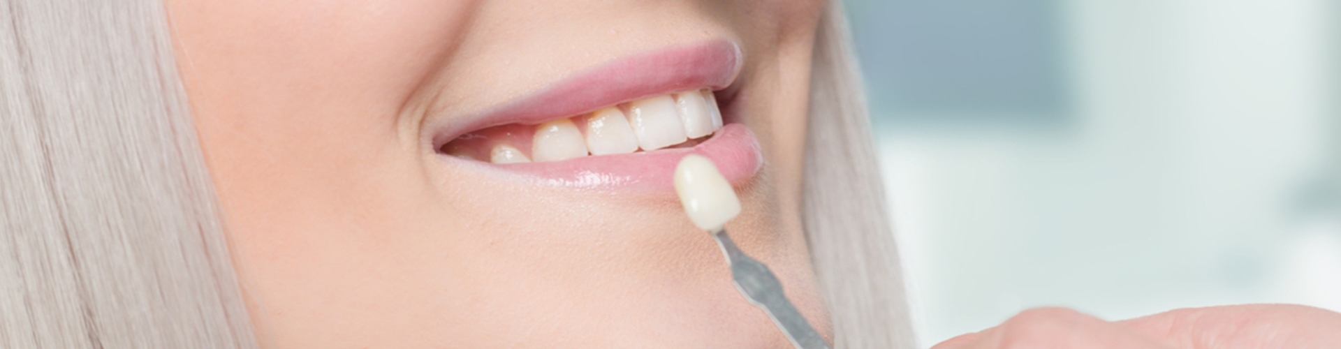 woman having veneer color matched
