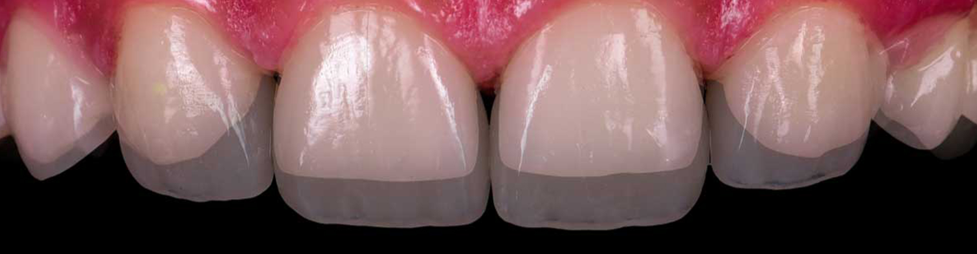 demonstrating the change after dental bonding