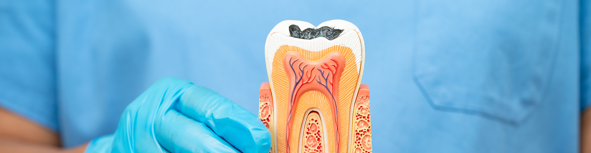 gloved hands holding tooth model with cavity showing root canals