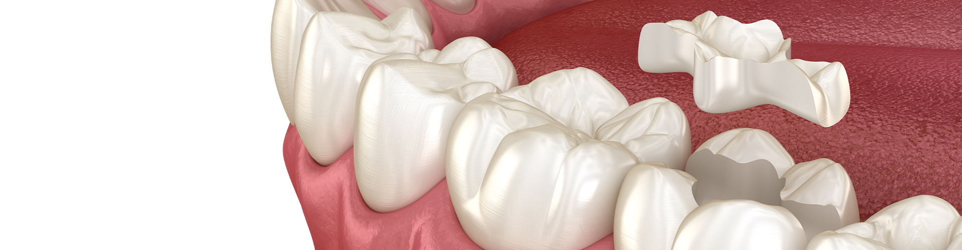 rendering of lower teeth with one getting an inlay