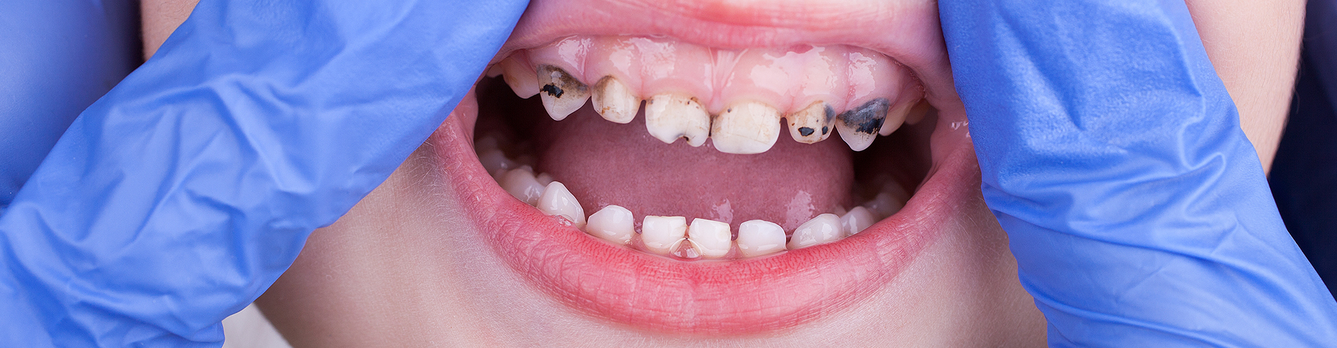gloved hands lifting child's upper lip to show decayed teeth