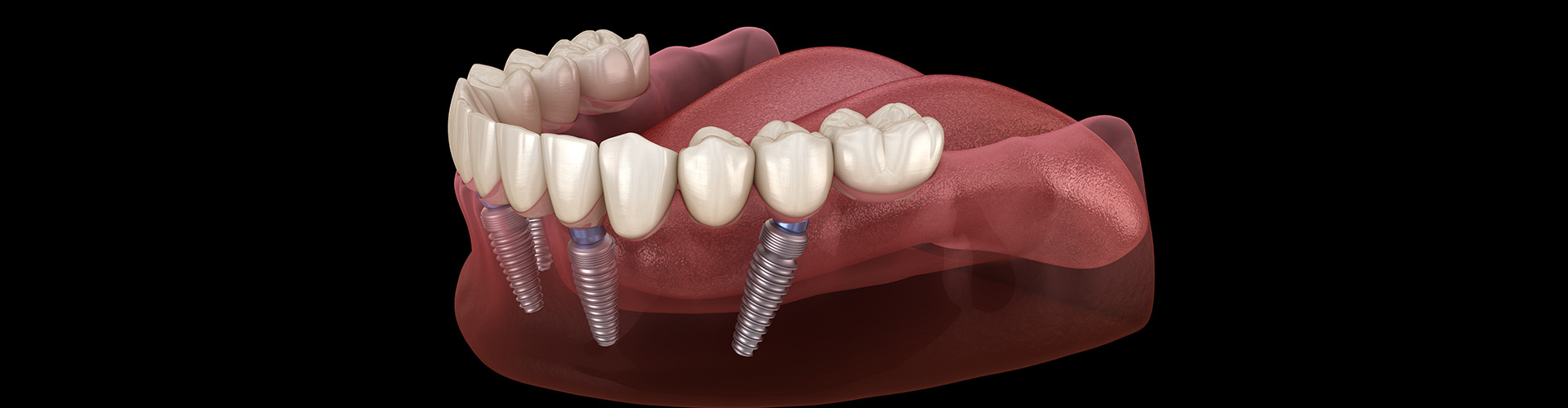 3D render of an All-on-4 dental implant.