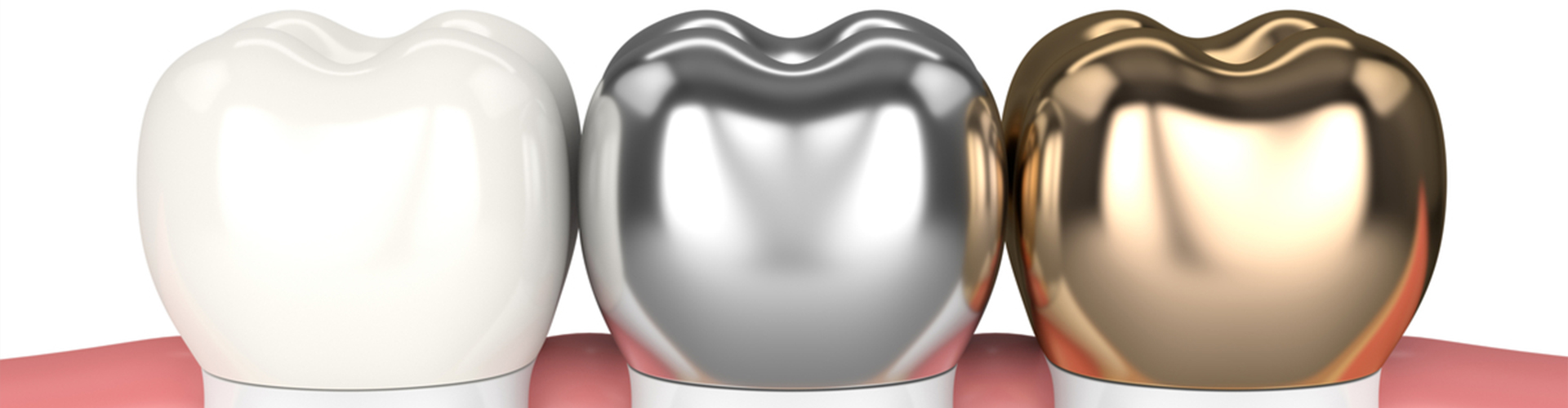 rendering of porcelain, silver, and gold crowns