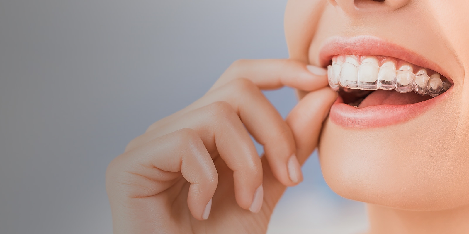 Close-up of a woman inserting her Invisalign aligner.