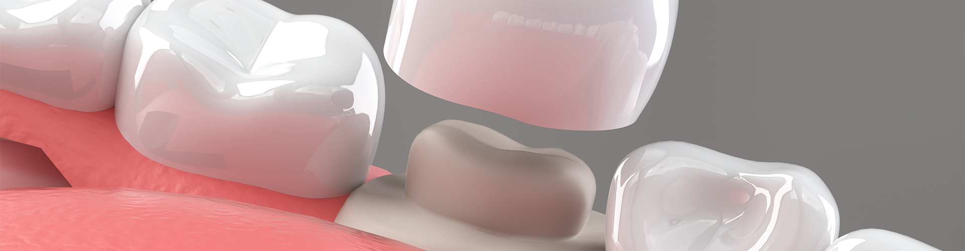 Model of a dental crown being placed between teeth.