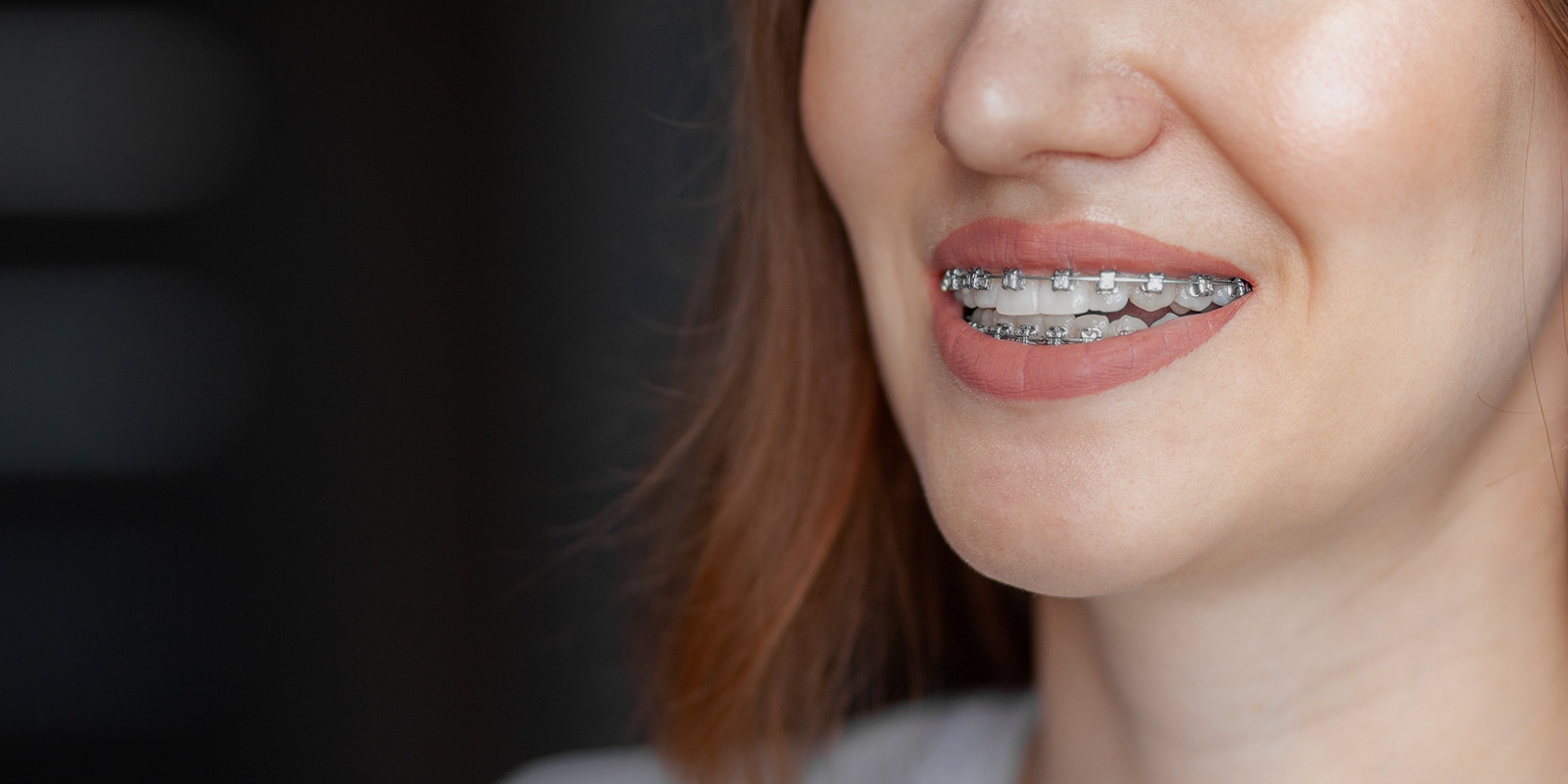 Close-up of a woman smiling with braces on her teeth.