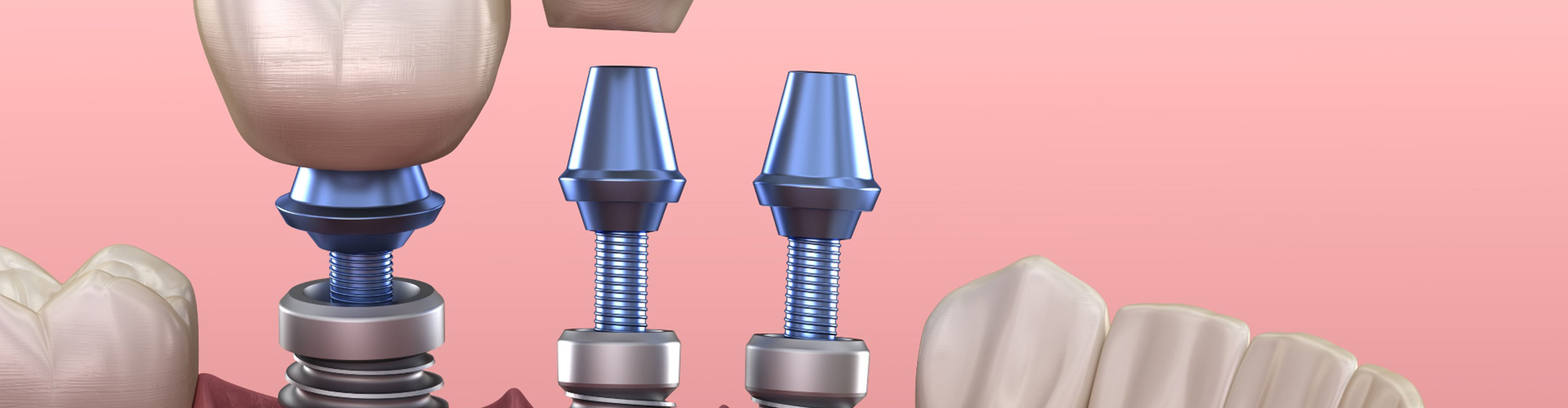 Rendering of 3 dental implants in a mouth.
