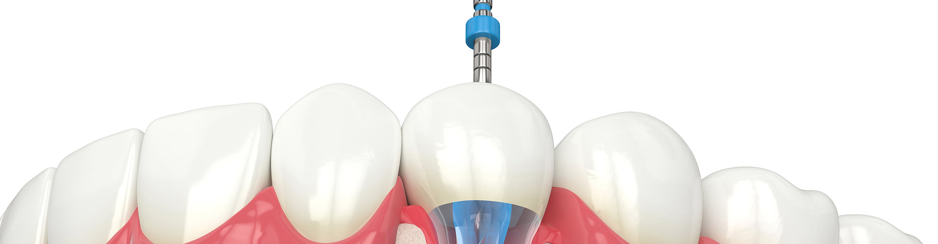 rendering of root canal therapy being performed on a tooth