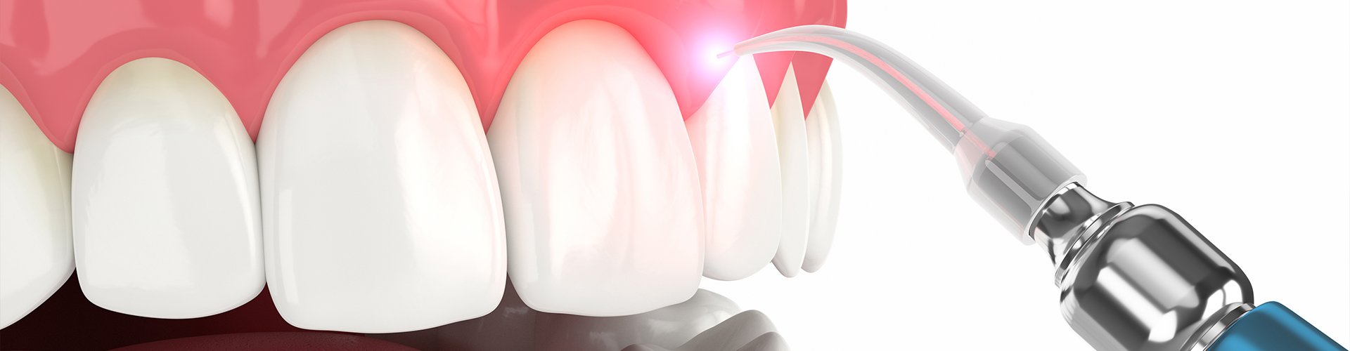 rendering of teeth having laser dental cleaning