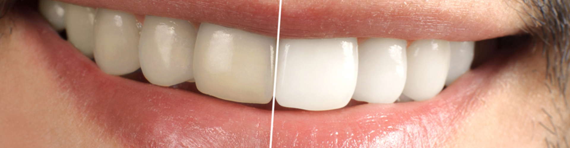 side by side of teeth whitening results