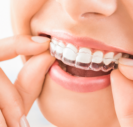 A woman smiling and pointing to her teeth.