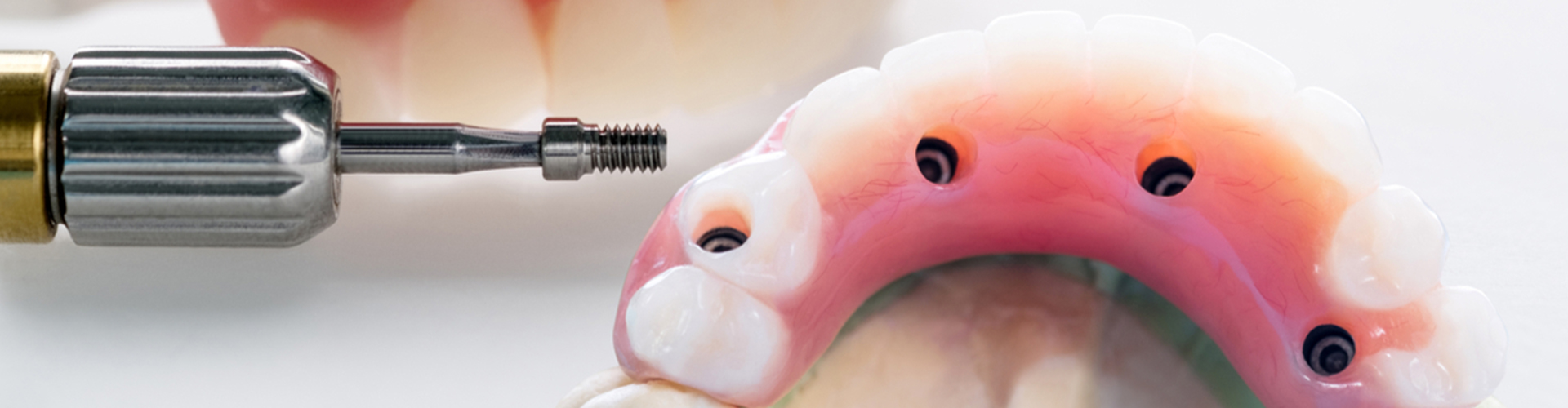 implanted supported dentures