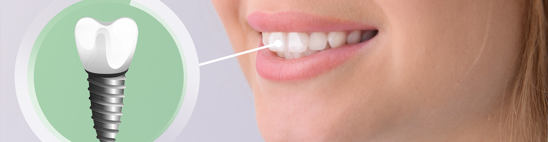 rendering of dental implant in front of woman's smile