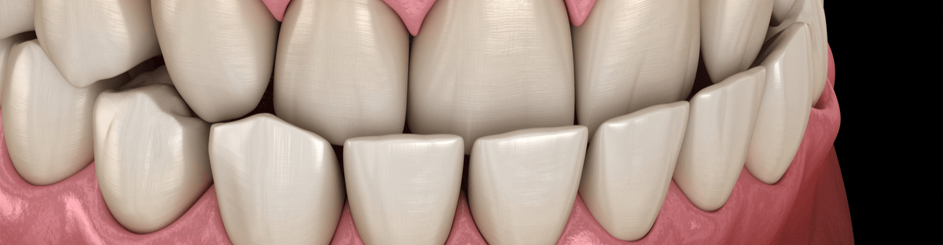 Rendering of an underbite.