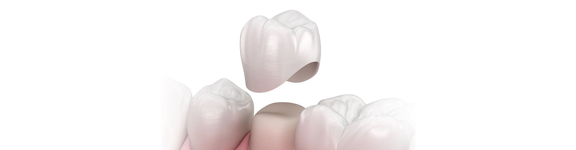rendering of a crown being placed onto a filed-down tooth