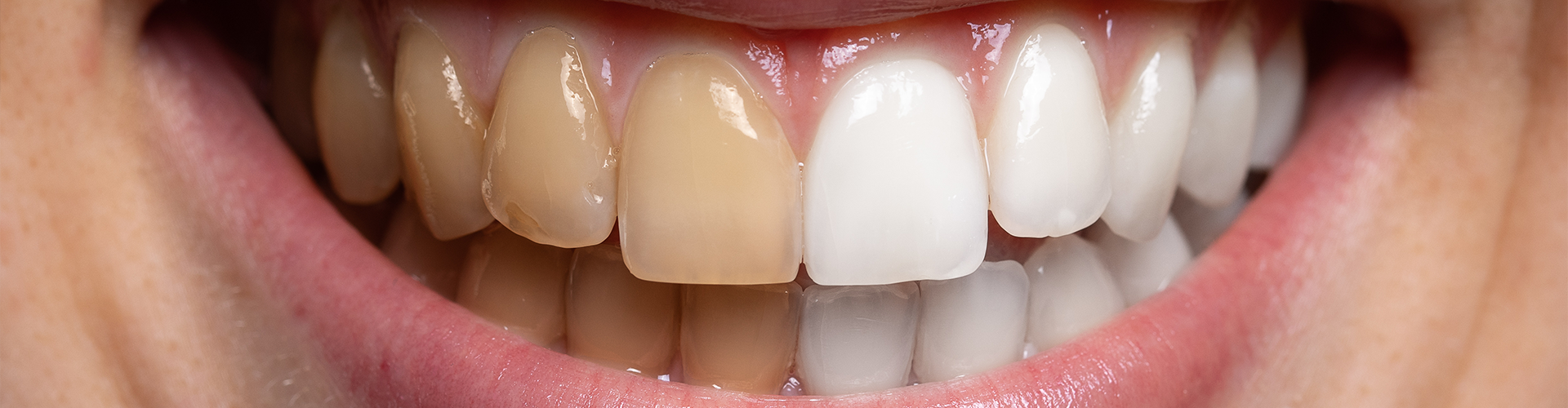 before and after of woman's smile undergoing teeth whitening