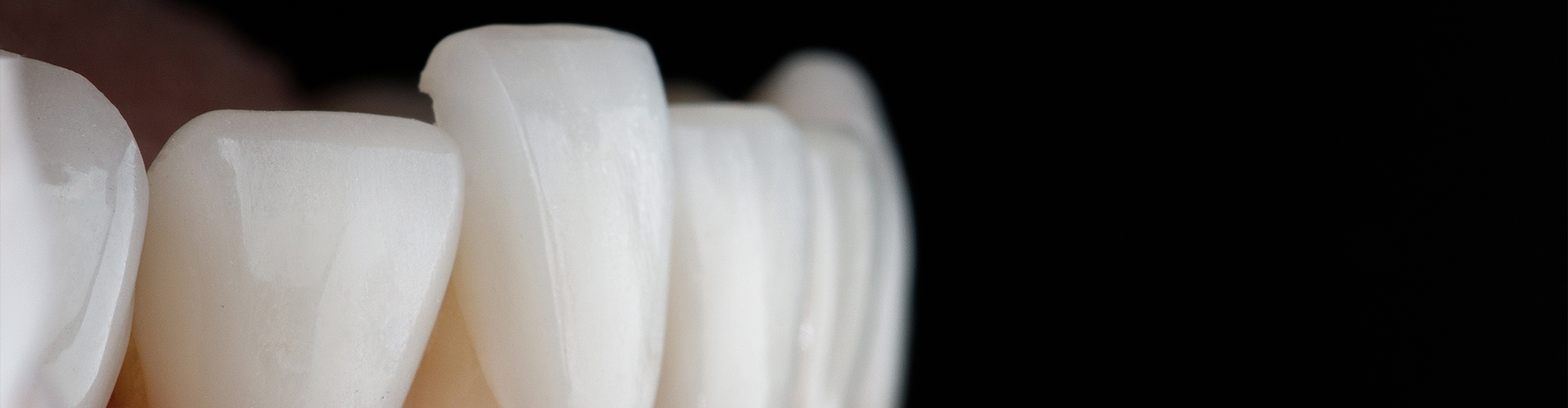 veneer being placed on a lower front tooth in a mouth model