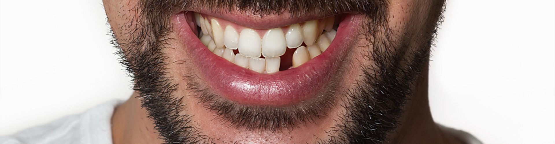 man smiling with a tooth gap