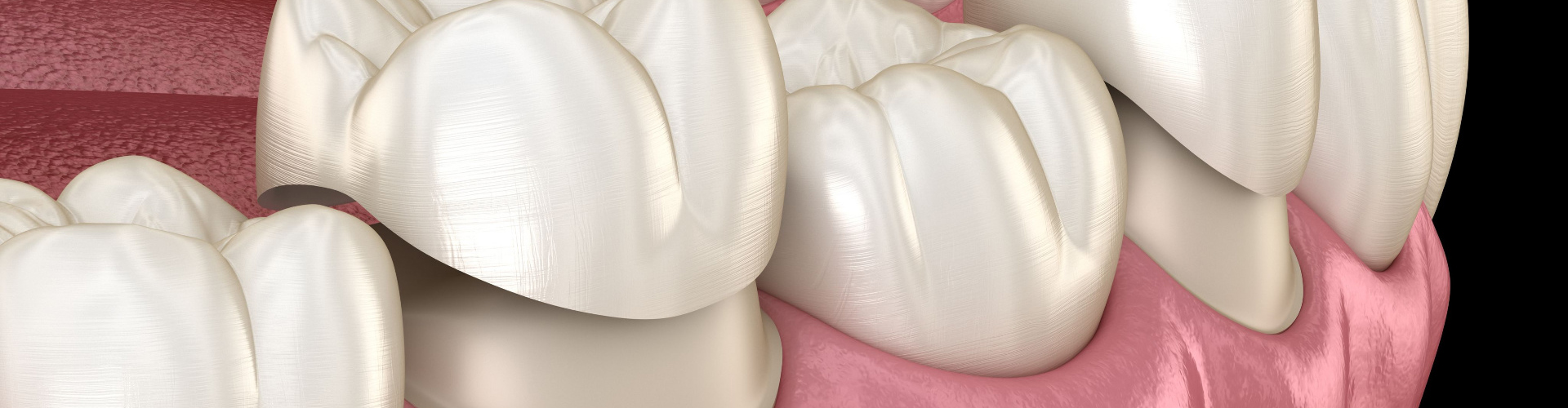 rendering of dental crowns over teeth