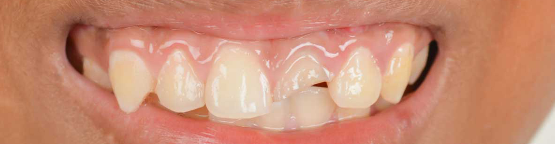 Female mouth smiling with chipped tooth.