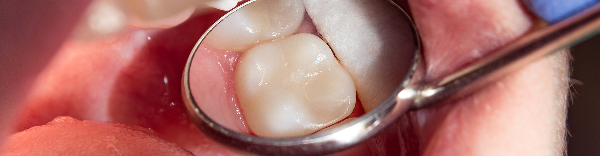 biting surface of tooth shown in dental mirror reflection