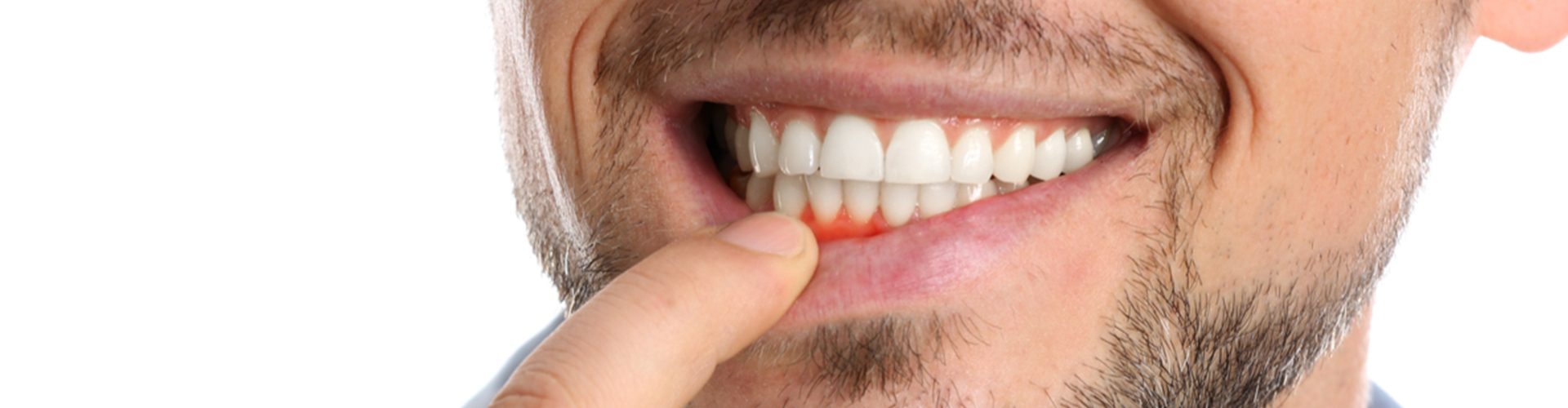man pulling down lip to show red gums