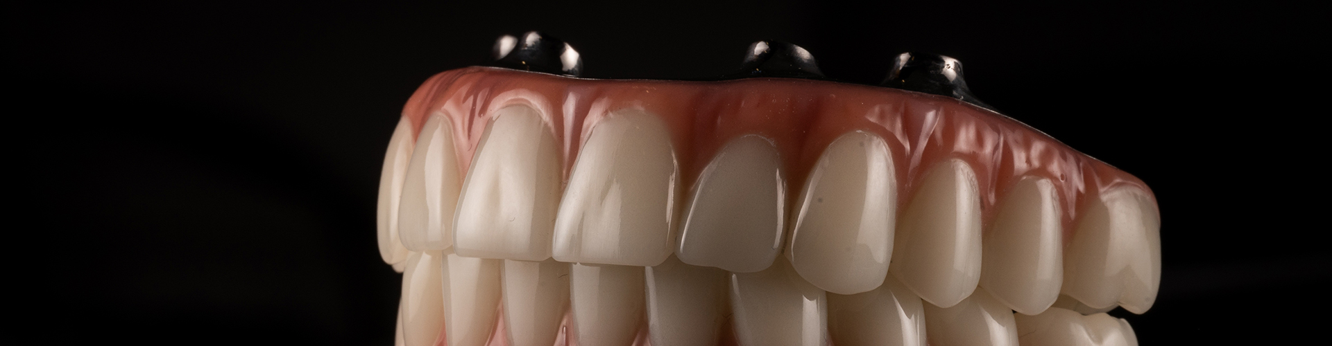 upper and lower implant-retained dentures