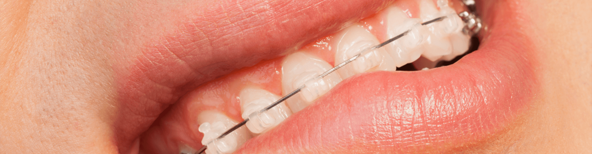 Mouth biting lip with ceramic braces.