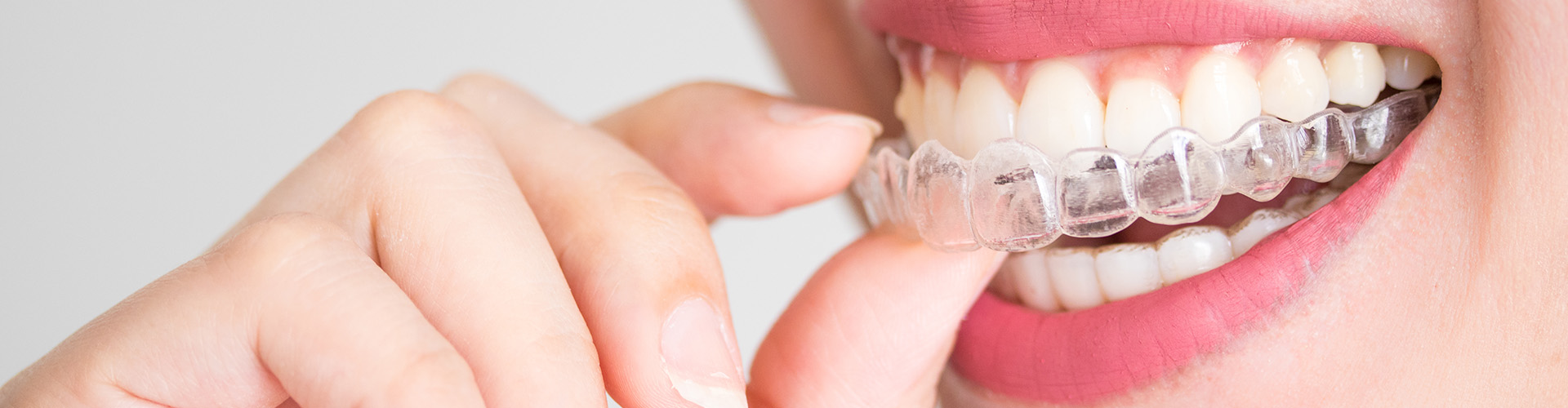 woman placing clear aligner in her mouth