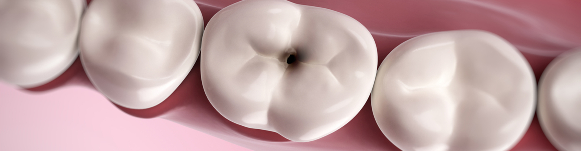rendering of a tooth with a cavity